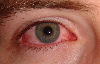 NHÃN VIÊM ĐỒNG CẢM - NGUYÊN NHÂN, TRIỆU CHỨNG VÀ ĐIỀU TRỊ